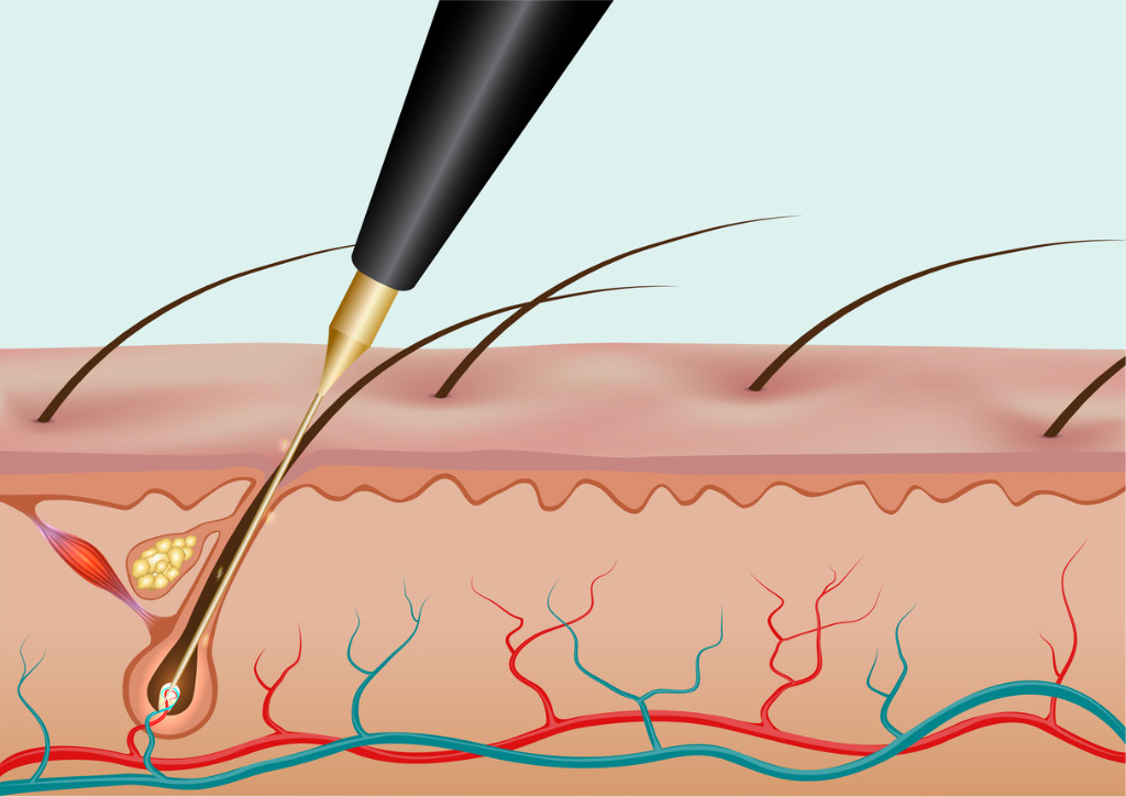 a diagram showing a handpiece inserted into a hair follicle. The piece rests at the bottom of the hair follicle, where the hair is connected to blood supply.